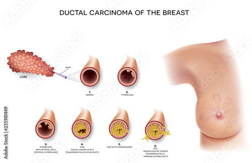 Ductal carcinoma of the breast, detailed medical illustration. At the beginning normal duct, then hyperplasia, after that atypical cells are invading, Ductal cancer in situ and invasive ductal cancer.