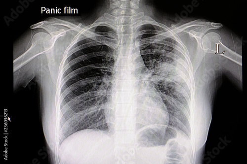 pneumonia chest film