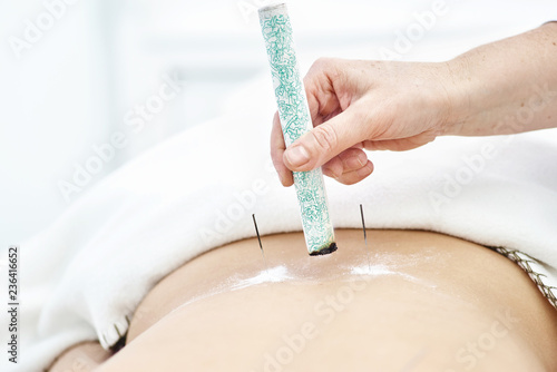 Woman being treated with acupuncture and moxibustion treatments