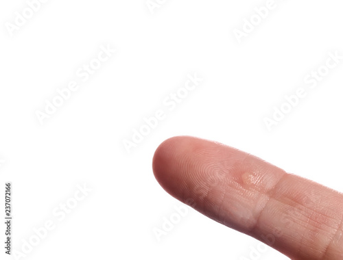 Finger on hand with wart close up, isolated on white background