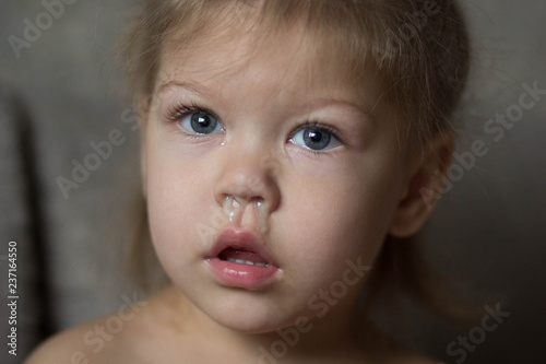 child with runny nose