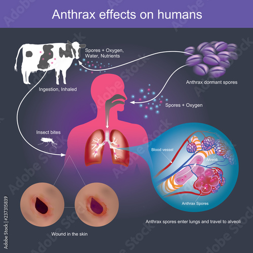 Anthrax effects on humans it can cause death.