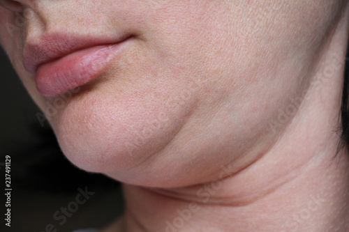 face line correction. a woman with a second chin