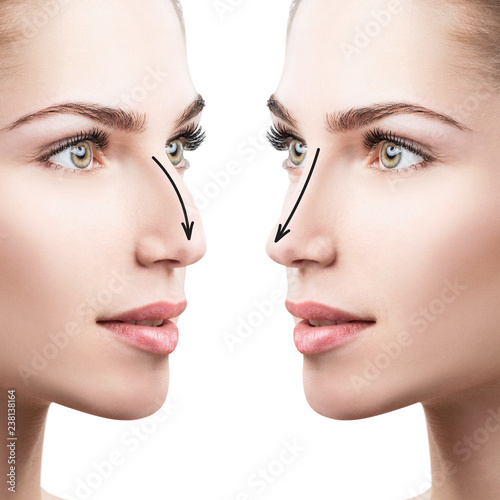 Female nose before and after cosmetic surgery.