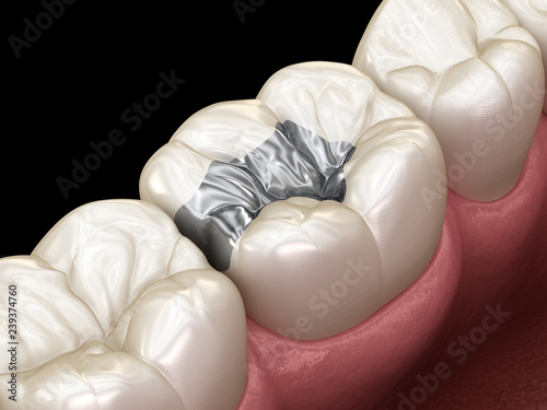 Inlay silver crown fixation over tooth. Medically accurate 3D illustration of human teeth treatment