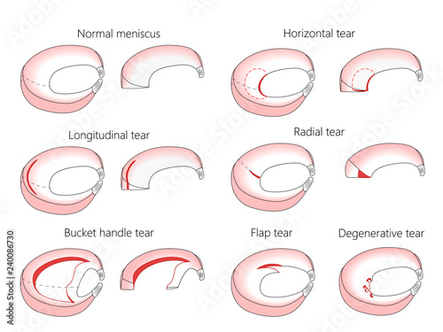 Vector illustration. Anatomy of a meniscus in the healthy human knee joint. Types of meniscal tear with cross section of the menisci. For advertising, medical publications