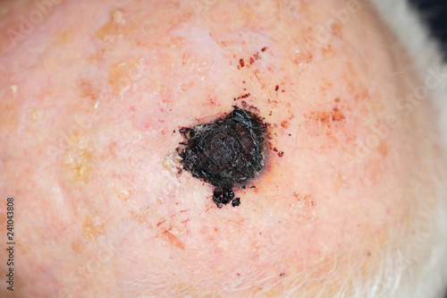 Malignant melanoma on the head of an old caucasian man