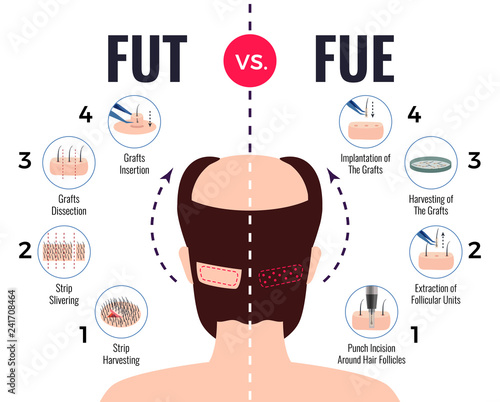 Hair Transplantation Fut Vs Fue 