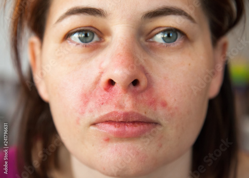 woman's face with perioral dermatitis
