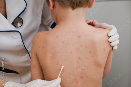 Doctor applying cream to baby's skin with blisters and rash caused by chickenpox