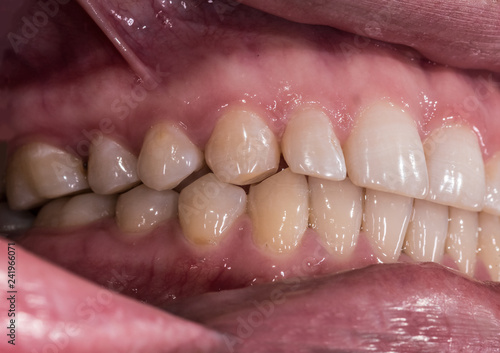 Healthy human teeth with normal occlusion from side view