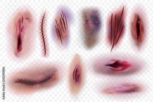Realistic scars. Wound, surgical stitches and bruis, skin cuts. Bloody wounds vector isolated set. Illustration of surgical scratch, cut wound and seam