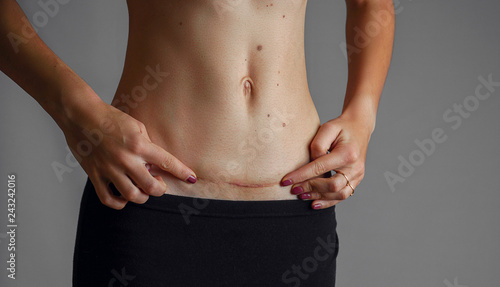 Closeup of woman belly with a scar from a cesarean section