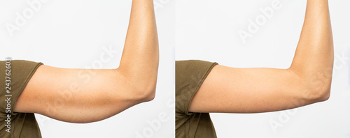Before and after excess skin removal under the arm