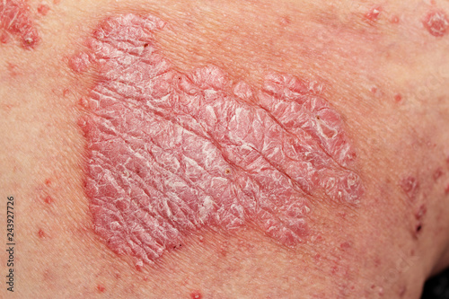 Detail of psoriatic skin disease Psoriasis Vulgaris with narrow focus, skin patches are typically red, itchy, and scaly