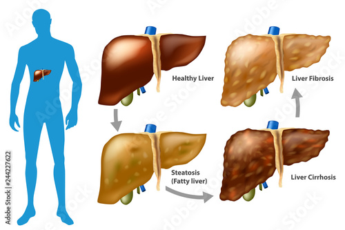 Stages of liver damage. The Progression of Liver Disease. (Steatosis,fibrosis, cirrhosis)