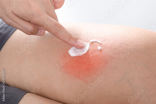 Scratch Allergic skin from mosquito or insect bites and apply medicine cream,Healthcare And Medicine concpet