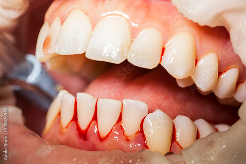 Zahnreinigung, Zahnfleischbluten