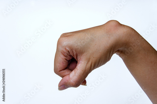 Ganglion cyst on woman hand on white background