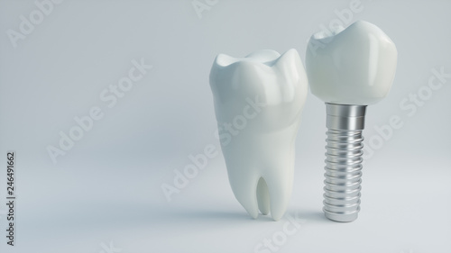 Tooth human implant - 3D Rendering