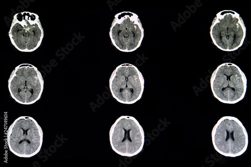 CT brain scan of ruptured cerebral aneurysm