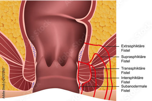 Typen von Analfisteln Illustration mit Beschreibung