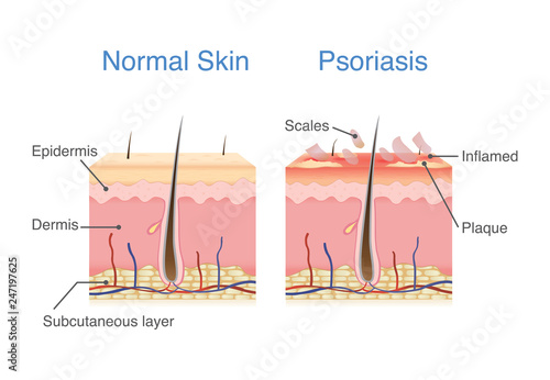 Normal skin layer and skin when plaque psoriasis signs and symptoms appear. illustration about dermatology diagram.