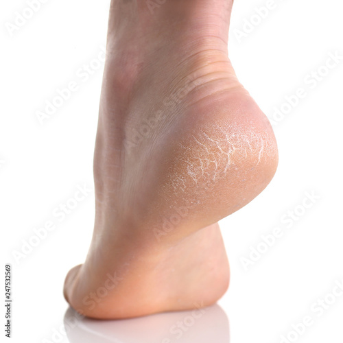 The heel of foot with bad skin covered with cracks