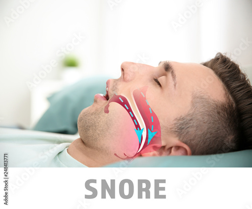 Illustration showing airway during snore