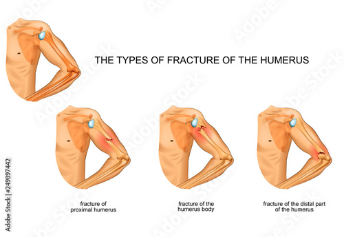 humerus fracture, trauma, surgery