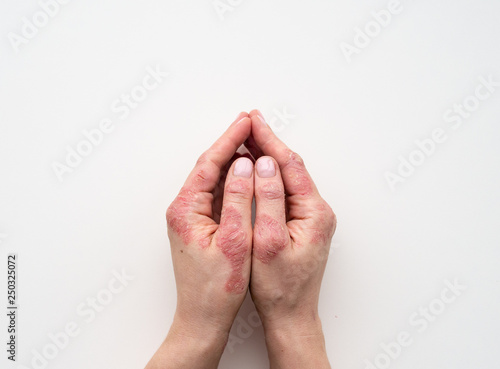 Psoriasis skin. Closeup of rash and scaling on the patient's skin. The concept of chronic disease treatment. Dermatological problems. Hard, horny and cracked skin in woman's hands. Dry skin. Isolated.