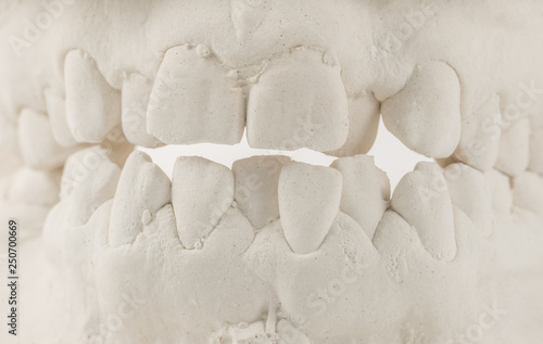 Dental casting gypsum model of human jaws. Crooked teeth and distal bite. Shots were made before treatment with braces . Technical shots on gray background