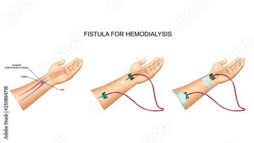 intravenous catheter, hemodialysis and fistula
