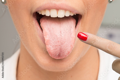Woman having candidiasis pointing her tongue with finger