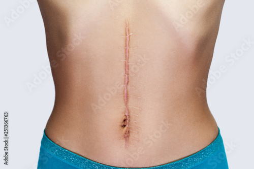 Closeup of young woman with large scar after surgery on abdomen. medical treatment and scars removal concept. indoor studio shot, isolated on grey background.