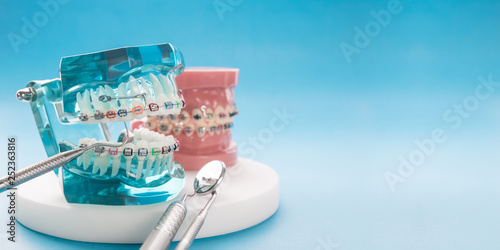 orthodontic model and dentist tool - demonstration teeth model of varities of orthodontic bracket or brace