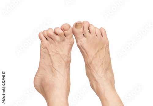 Rheumatoid arthritis in the feet.