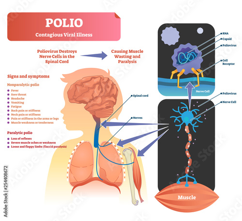 Polio vector illustration. Labeled medical virus infection symptoms scheme.