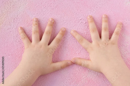 White baby hands affected by the wart with selective focus on blurred pink background. Papillomavirus on kids skin. Warts disease in a child's hand and fingers. Pediatric dermatology. Skin diseases