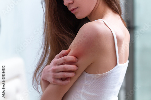 Young woman suffering from itching on her skin and scratching an itchy place. Allergic reaction to insect bites, dermatitis, food, drugs. Health care concept. Allergy rash