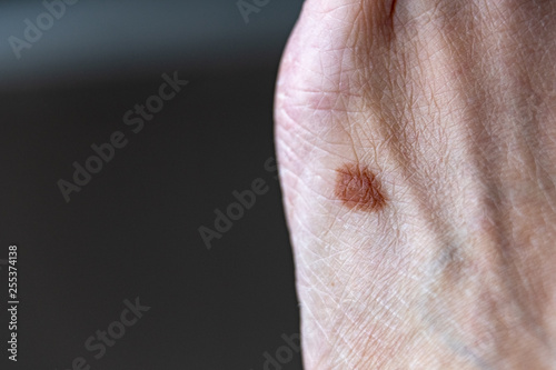 Mole on Human Foot