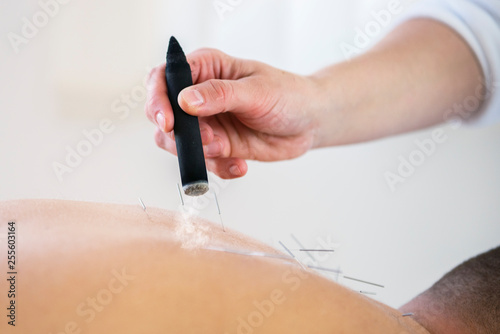 moxibustion and acupuncture treatment