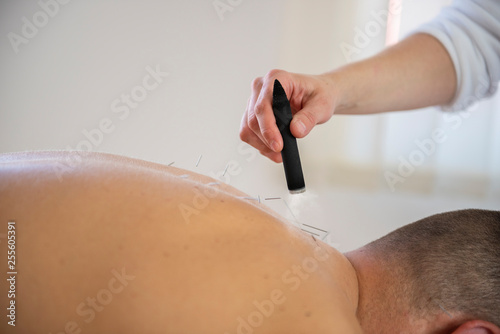 moxibustion and acupuncture treatment