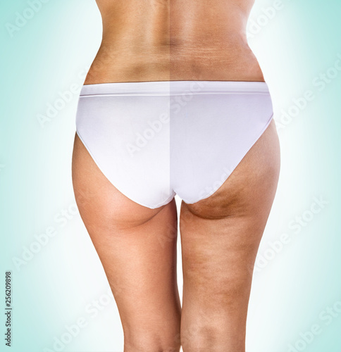 cellulite treatment