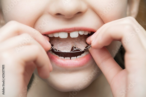 A girl wears a removable orthodontic appliance. Concept of pediatric dentistry, correcting the bite. Closeup, selective focus