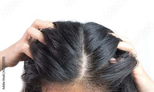 women head with dandruff Caused by the problem of dirty. Or caused by skin disease or Seborrheic Dermatitis. It has white scaly and it will cause itch.