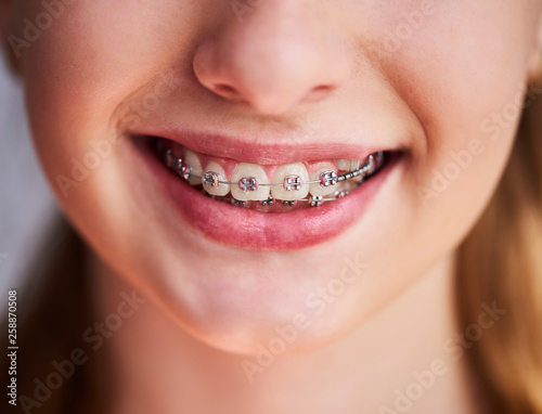 Close up of teeth with braces