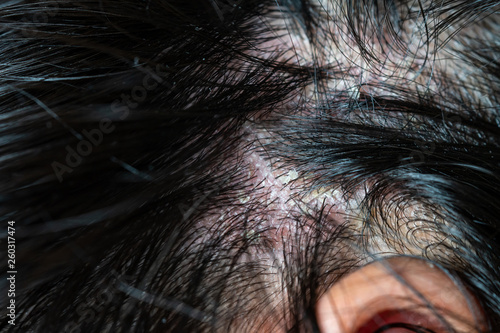 Skin diseases, on the scalp ,Woman with dandruff in her dark hair