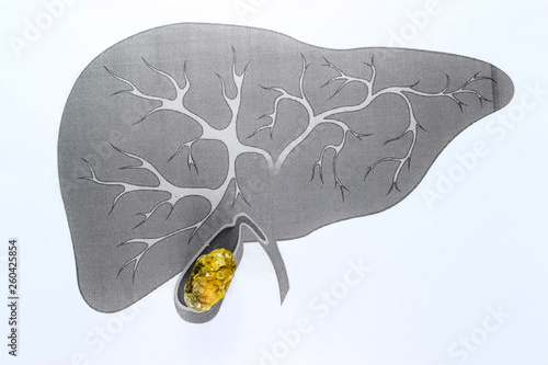 Gall bladder stone, schematic depiction, large sized Gallstone, Result of gallstone disease.