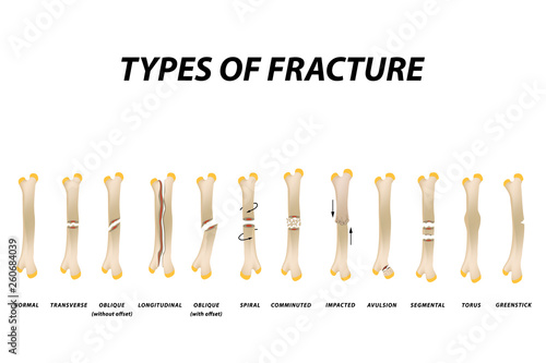 Types of fracture. Fracture bone set. Infographics. Vector illustration on isolated background.